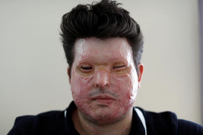 Outside The US: The UK Acid Attacks